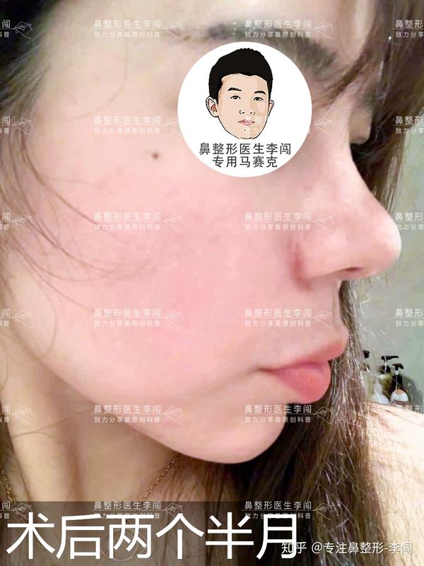 做完鼻子太高了!来看看这份最全恢复期科普!