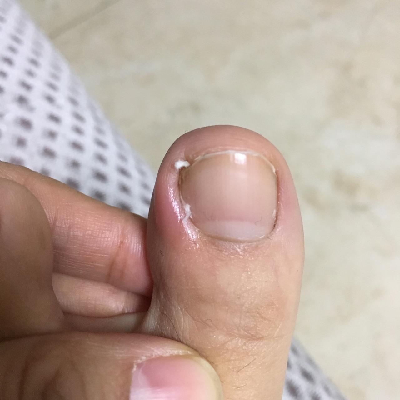 嵌甲,甲沟炎(附图)?