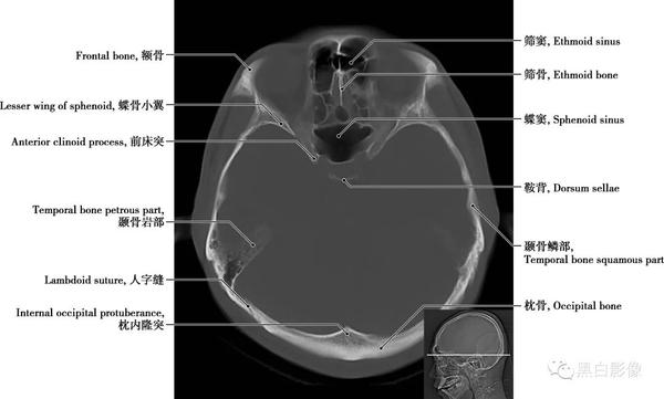 详细标注版！颅脑CT正常解剖图谱 - 知乎