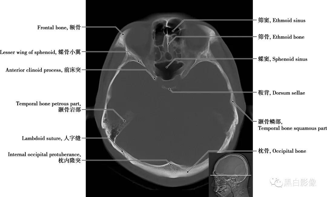详细标注版！颅脑CT正常解剖图谱 - 知乎
