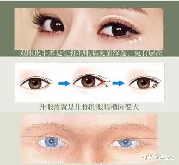 双眼皮提肌什么是提肌无力为什么医生建议你做提肌