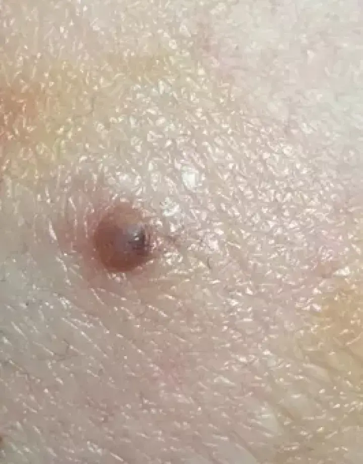 几个月内身上突然长好多黑痣褐色很小的那种挂皮肤科擅长色素沉积的