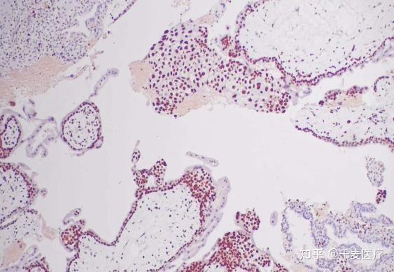 图15:ki-67呈阳性表达(×10)最终病理诊断:完全性葡萄胎.