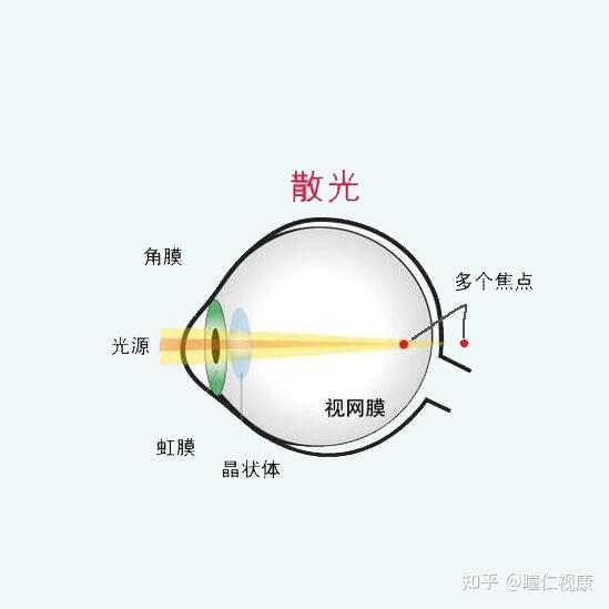 散光能做激光手術嗎? - 知乎