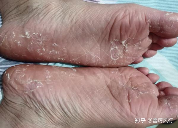 【角化型脚气正确根除方式】