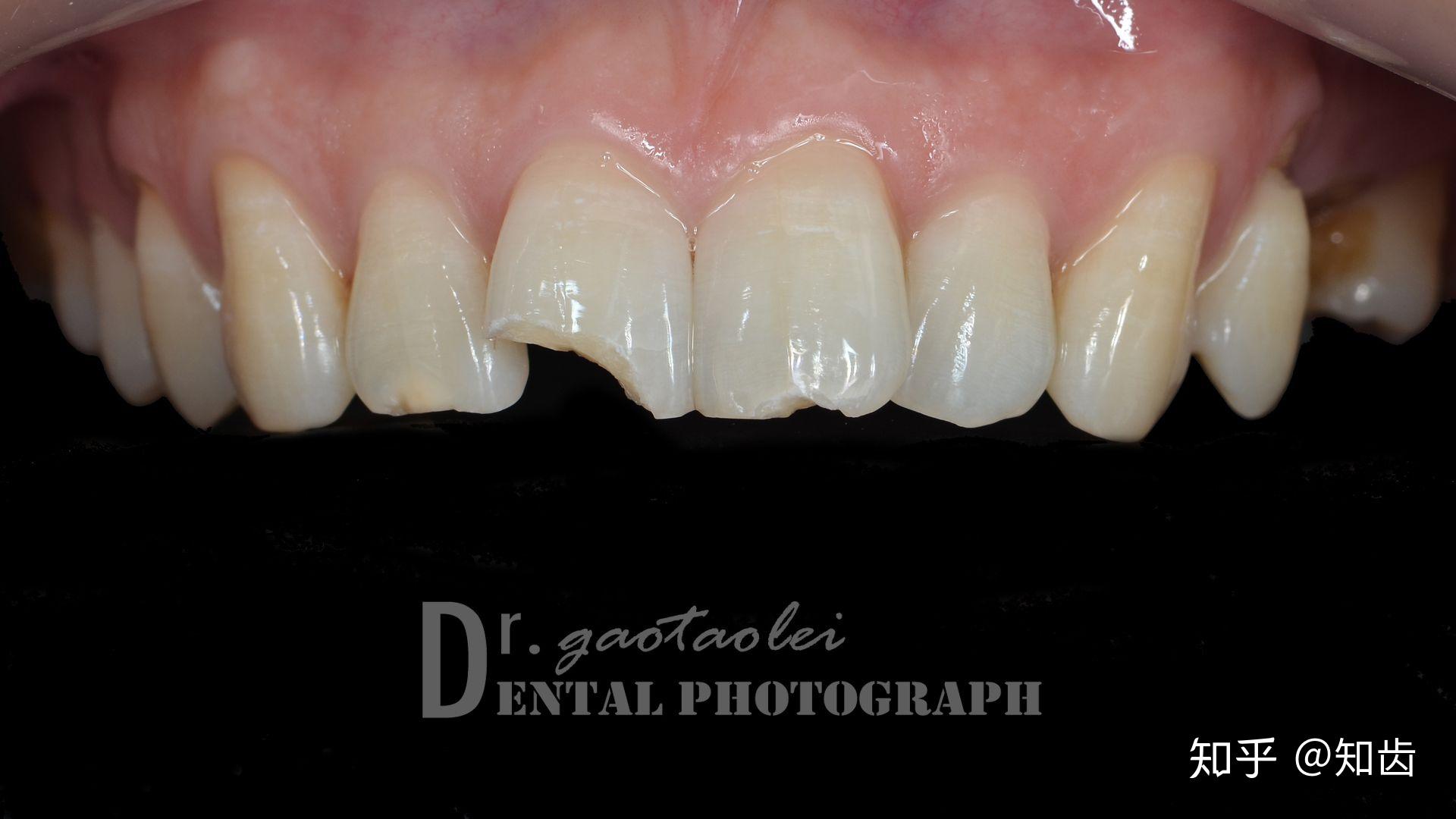 断牙会自然愈合吗