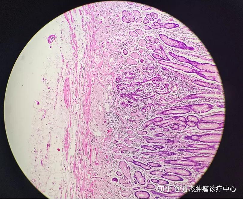 食管癌显微镜下图片图片