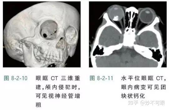 “眼癌”——可怕的儿童恶性肿瘤！ - 知乎