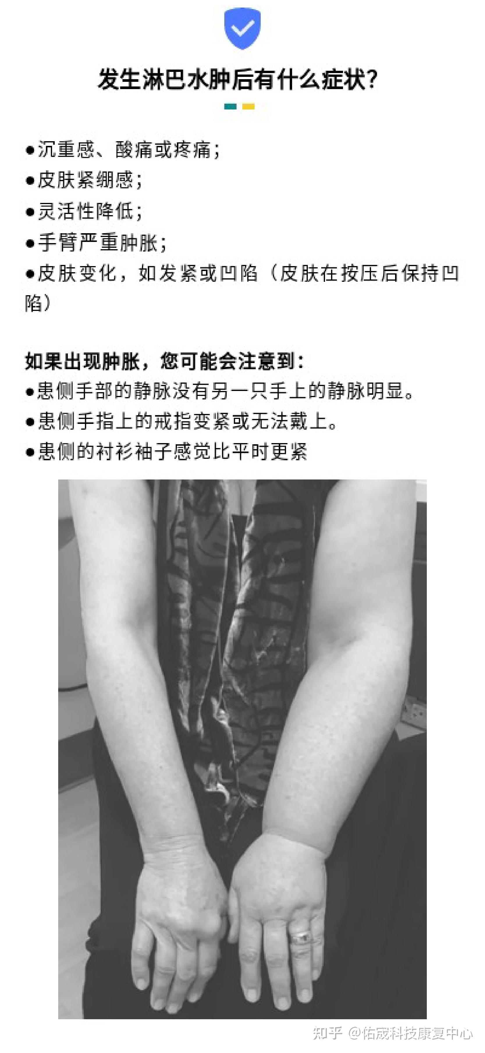 乳腺癌治疗后的淋巴水肿 - NEJM医学前沿