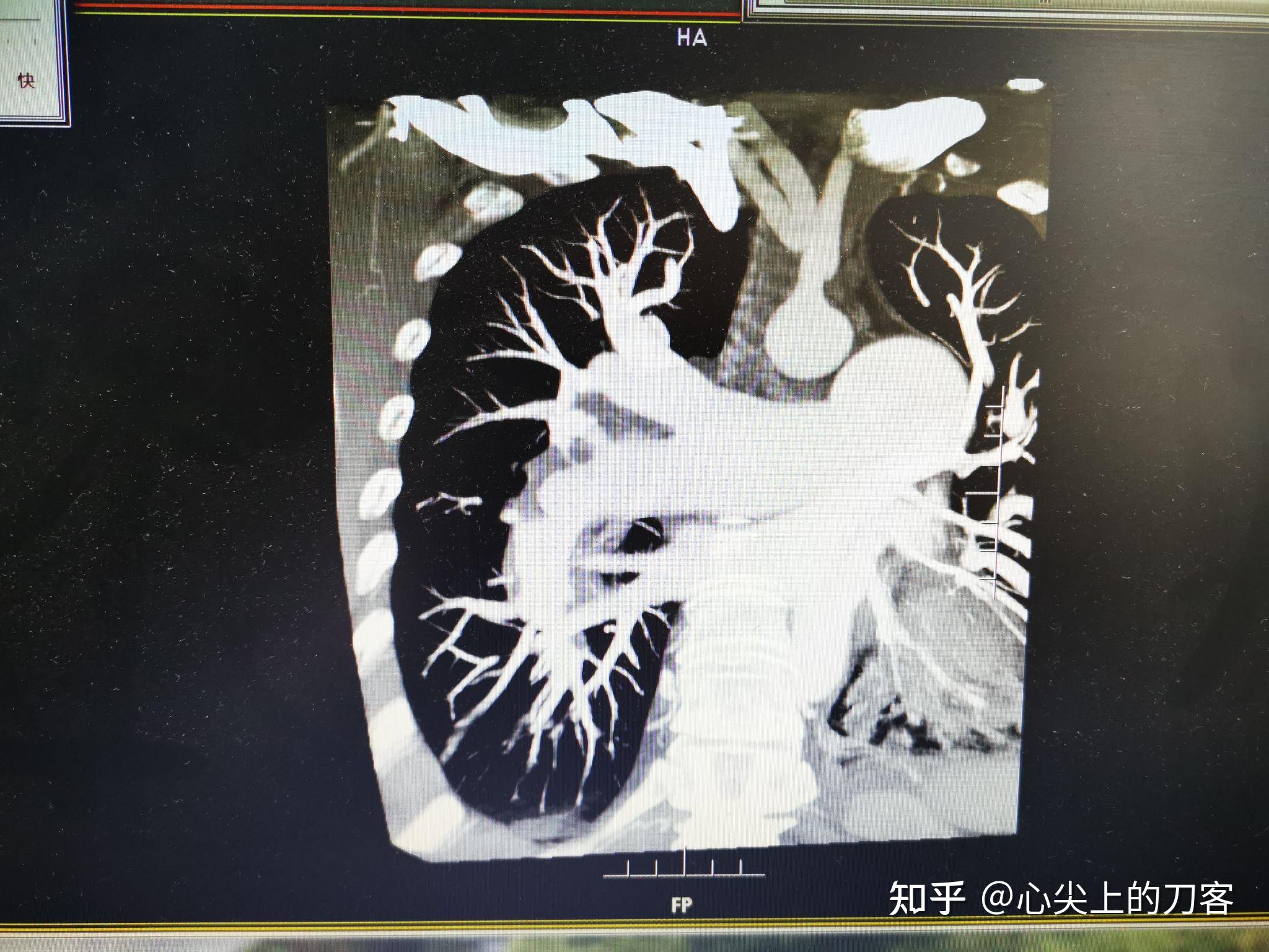 慢性血栓栓塞性肺动脉高压该如何治疗 知乎