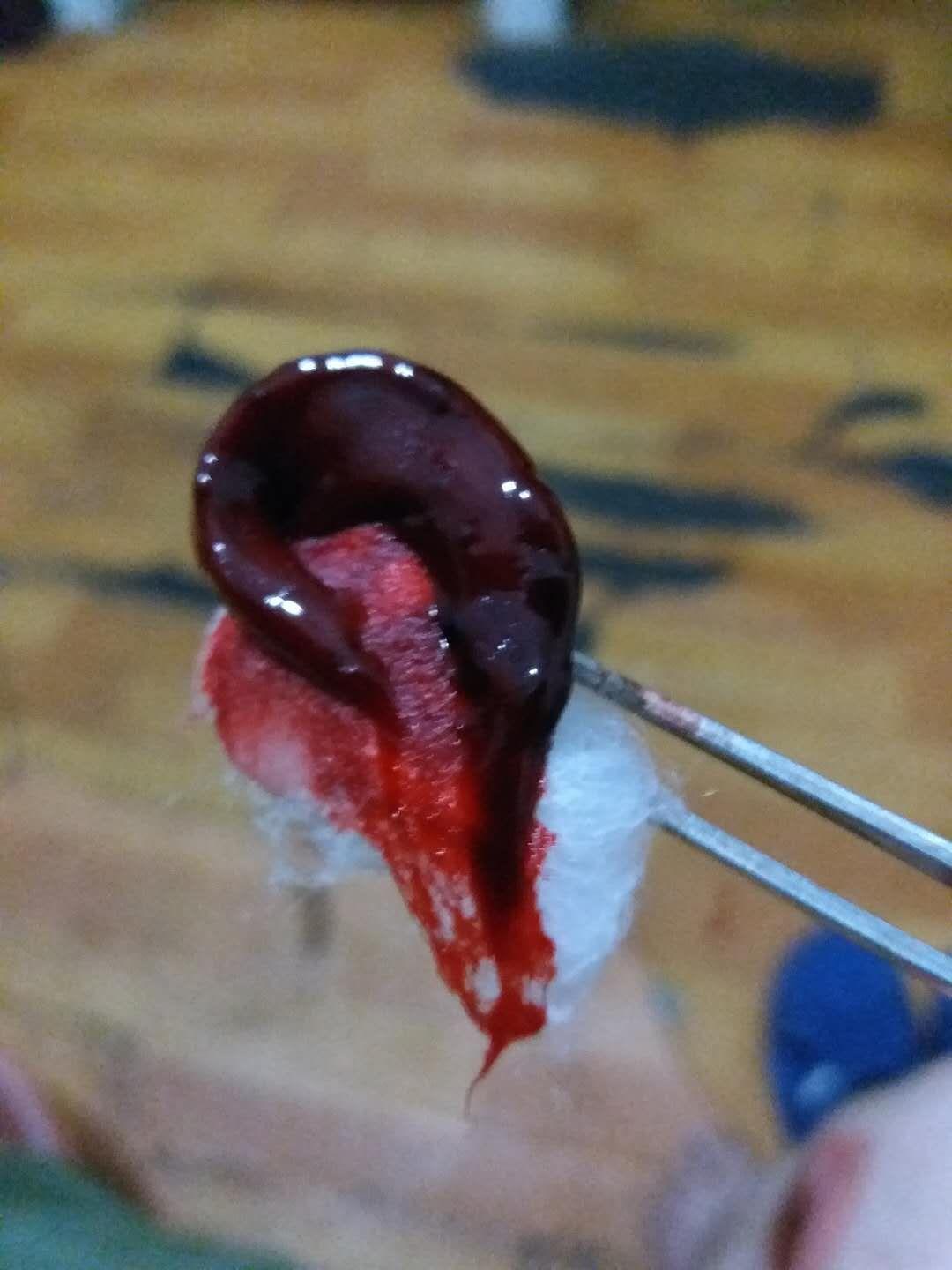 拔火罐有果冻状血块真的是湿气吗 ? - 知乎