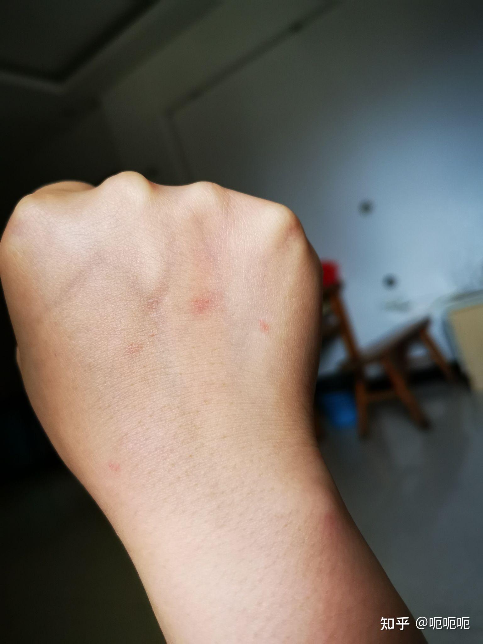 原发性免疫性血小板减少性紫癜 - 知乎