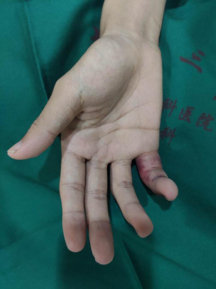 如果你家孩子爱打篮球,那么必须教会他手指被戳伤怎么处理 - 知乎