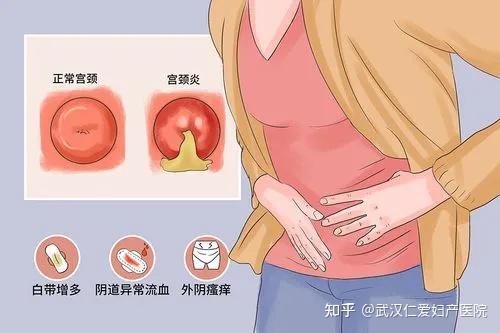 加上子宫有排除异物的倾向,使增生的粘膜逐渐自基底部向宫颈外口突出