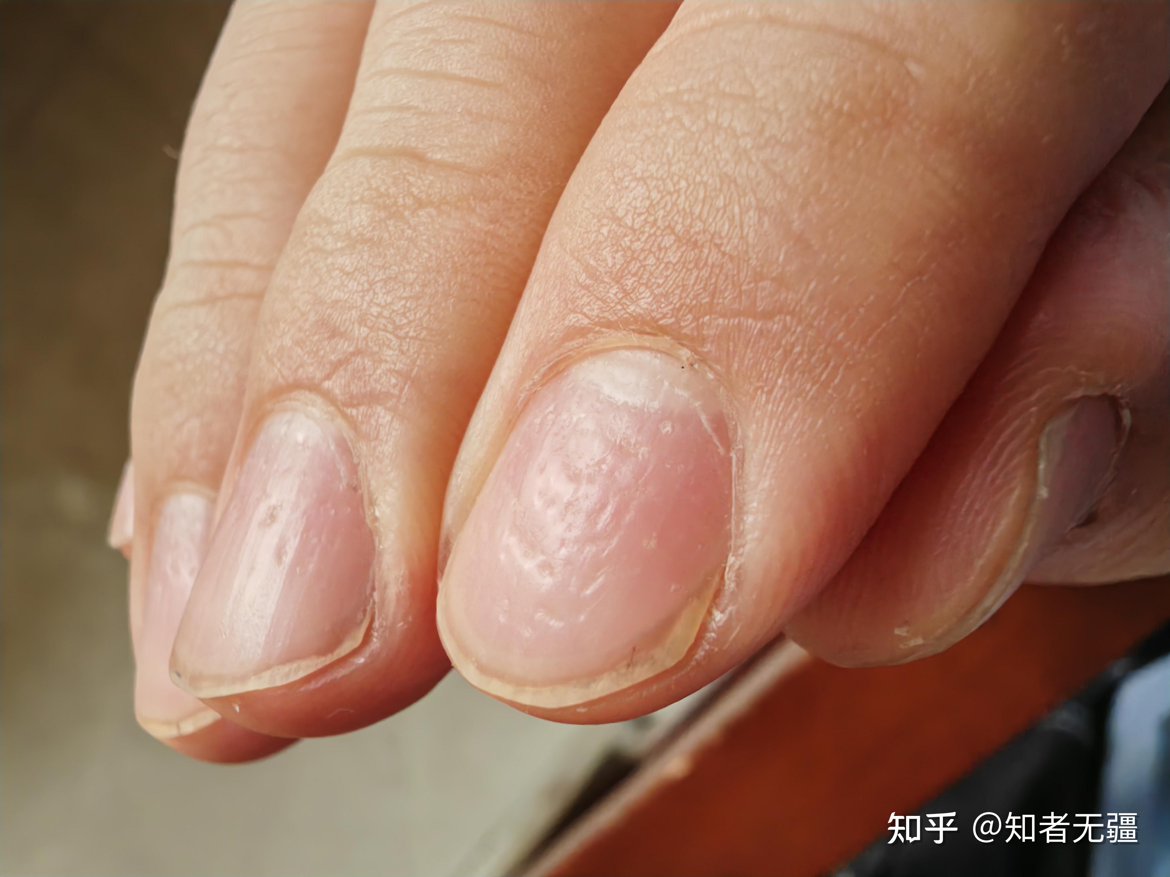 手指甲上全是小坑是怎么回事呢