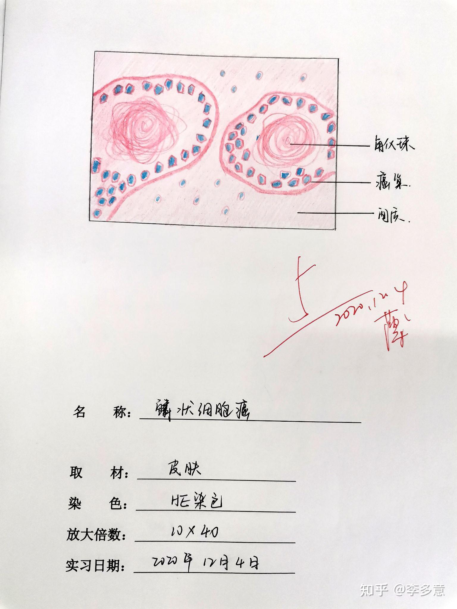 病理紅藍鉛筆圖存檔(僅供參考) - 知乎