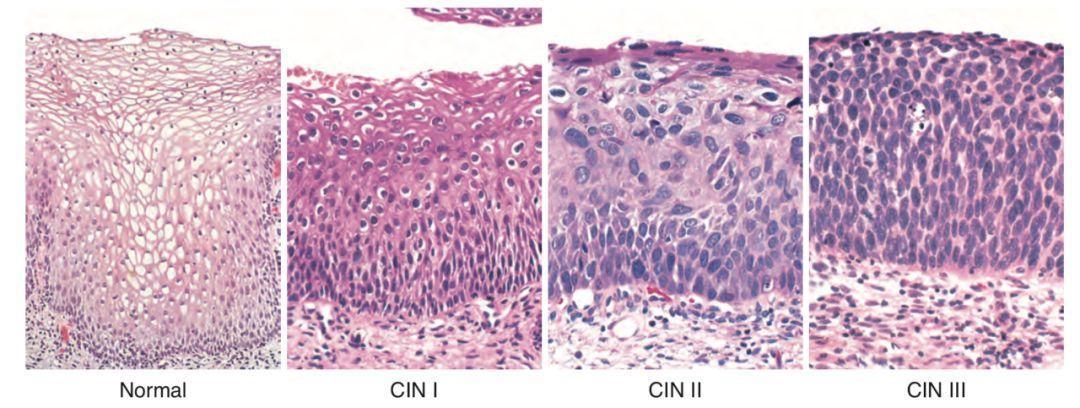 cin2原位癌從拒賠到正常理賠不用打官司