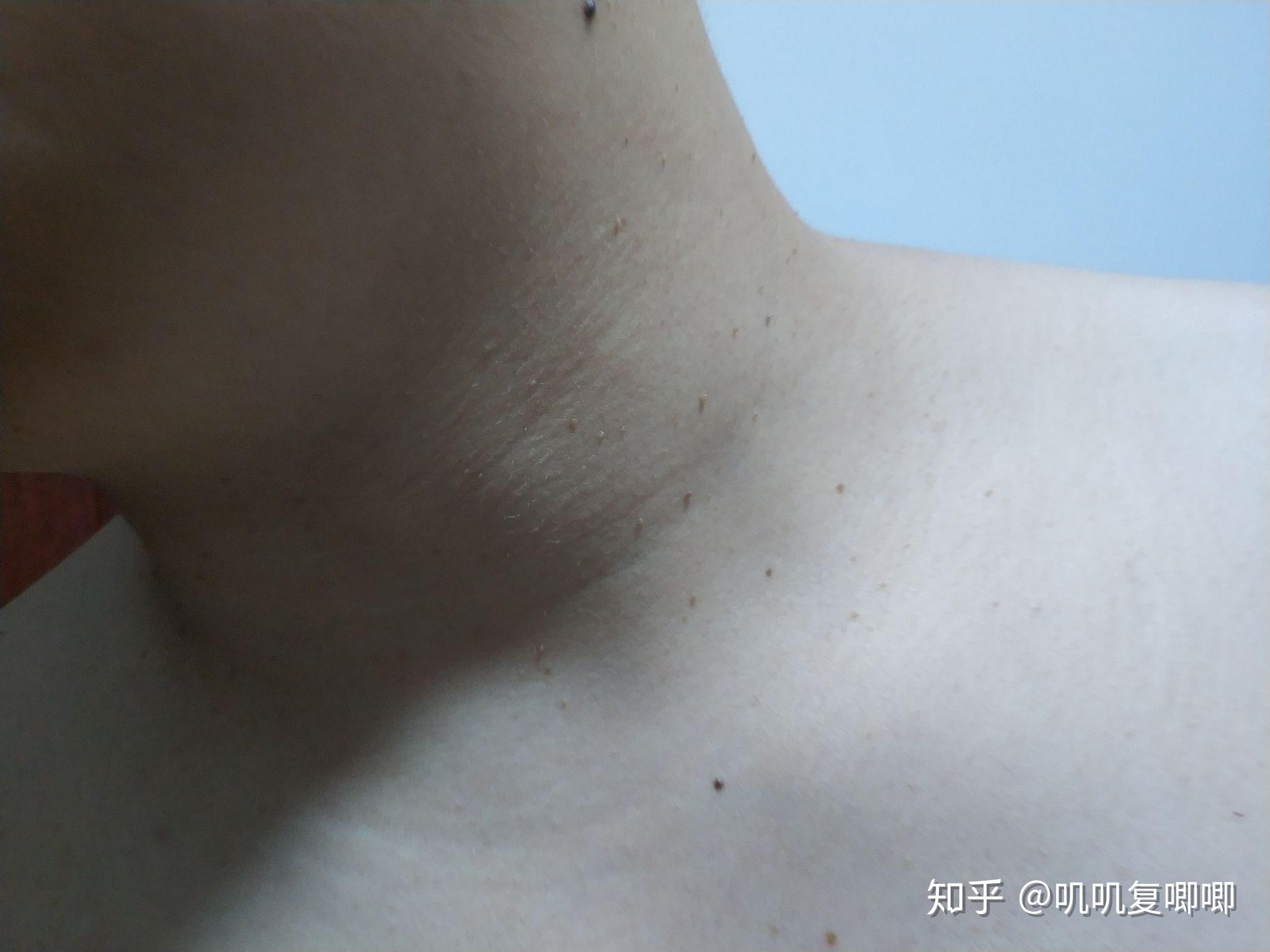 丝状疣初期图片脖子图片