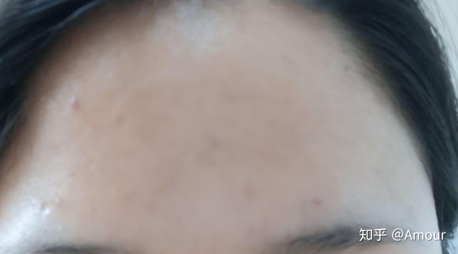 怎么才能不长痘痘学生 v2-edf2d662fa26a5565b7a00387788c77c_r.jpg