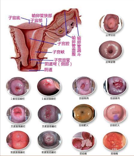 女士感染hpv图片女性图片