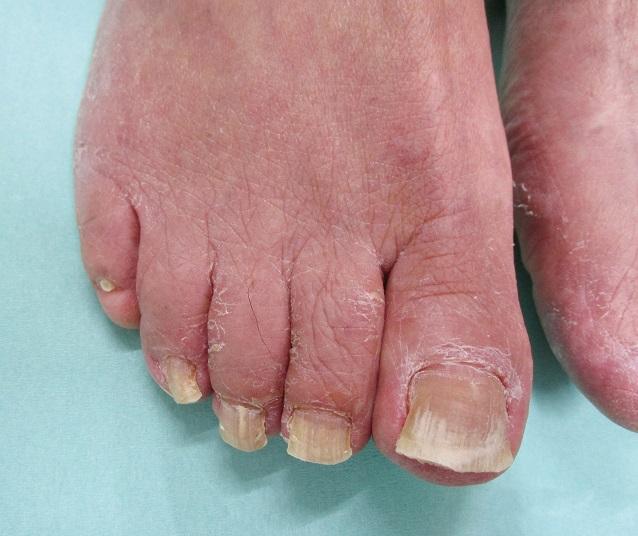 脚指甲病变的各种图片图片