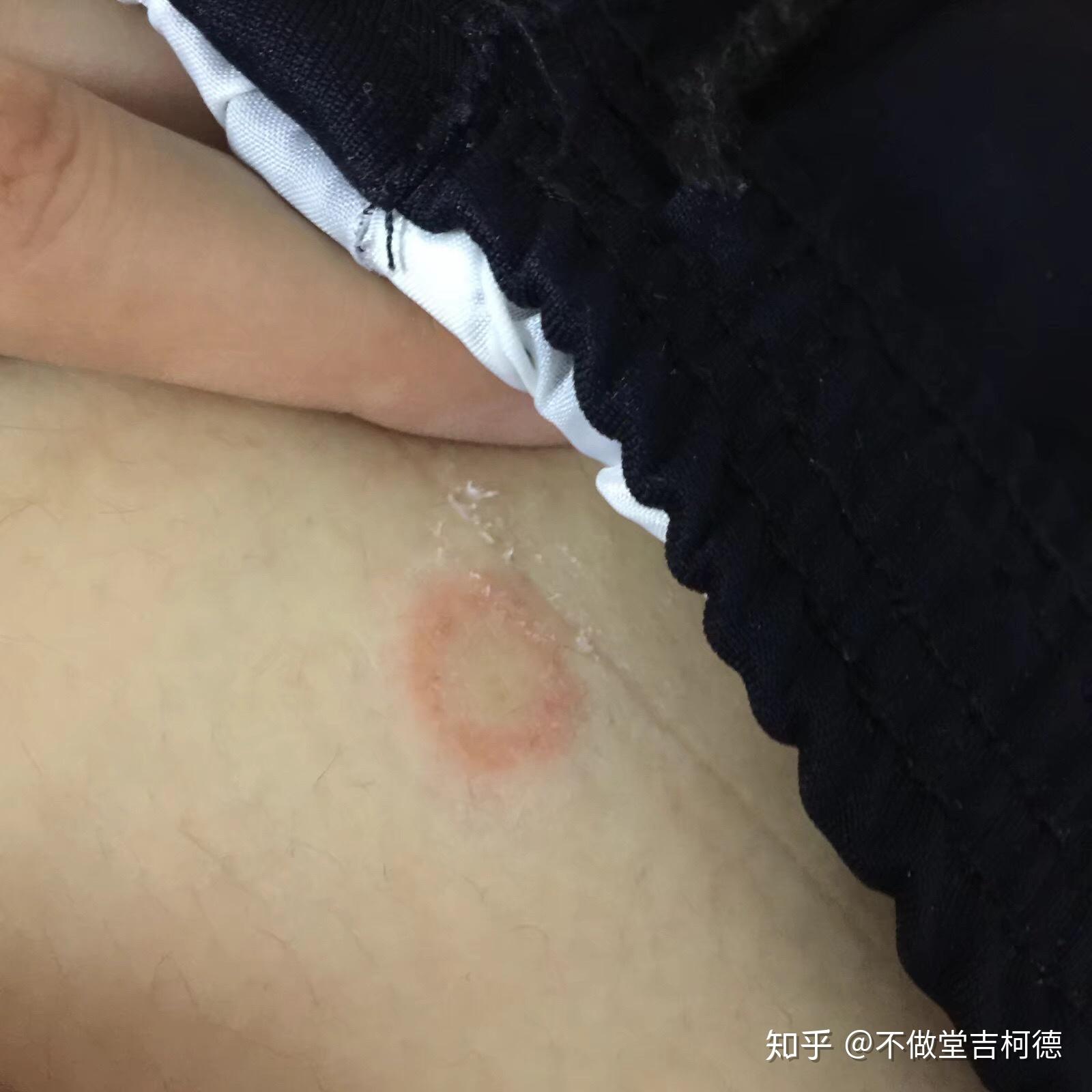 貓癬傳染人如何才能治好