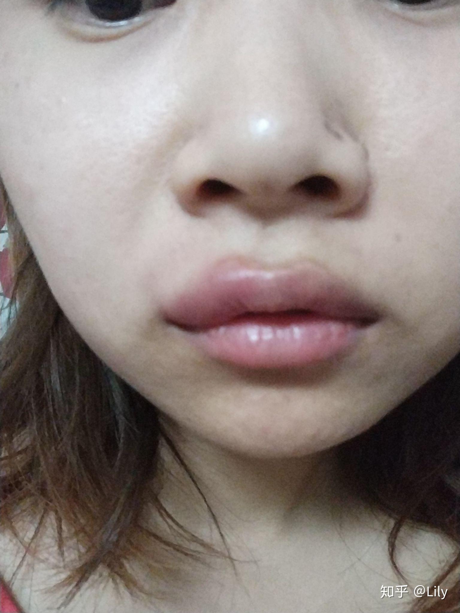 为什么嘴唇被蚊子叮了会肿很大? - 知乎