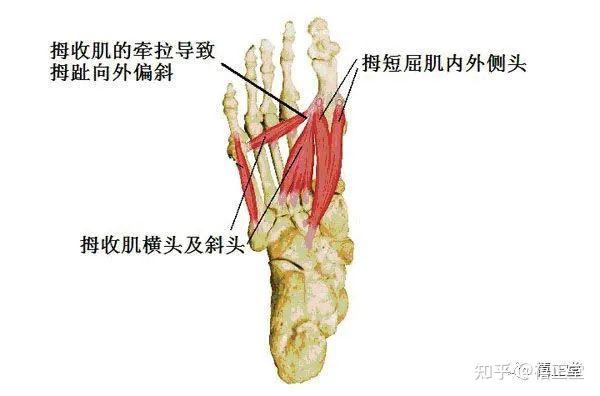 什么是拇外翻 - 知乎