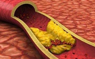 什么是动脉粥样硬化的标准 v2-ee4ac5837f7c0d9a949951d36b5c1ccc_b.jpg