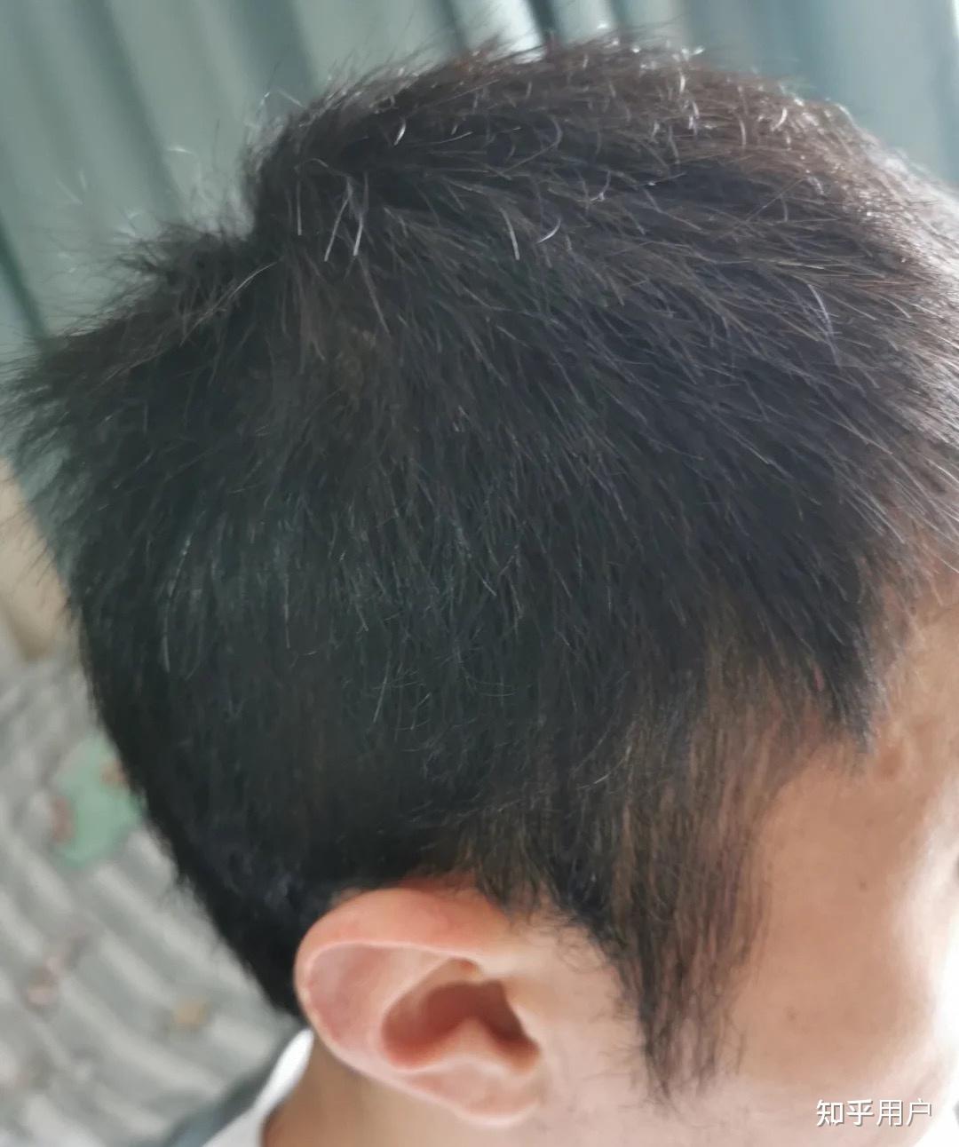 大三的一个男生,21岁,头顶漩涡处头发少得可怜,以前头发很茂密,晚上