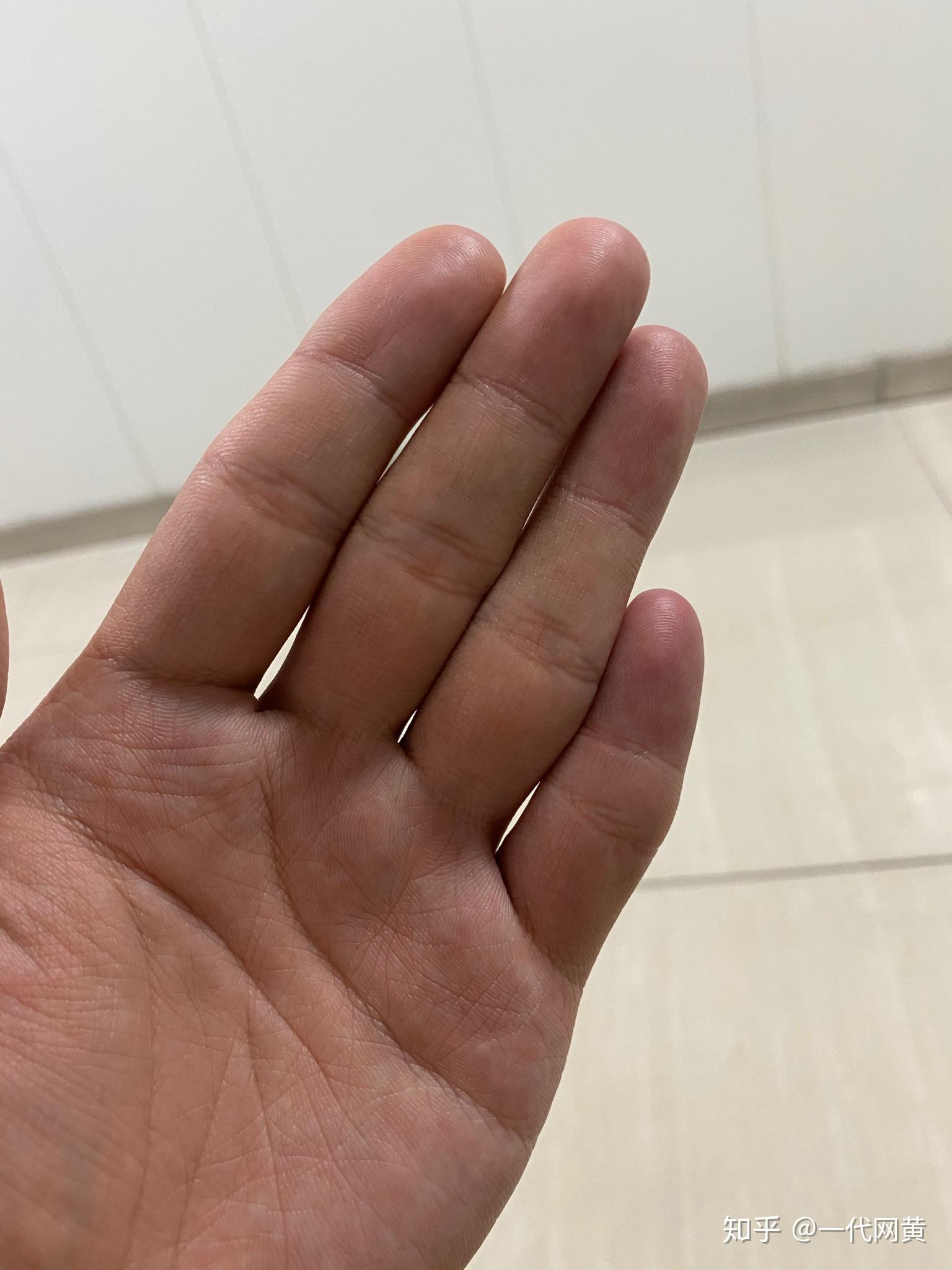 我的小拇指特别短特别奇怪究竟是为什么? - 知乎