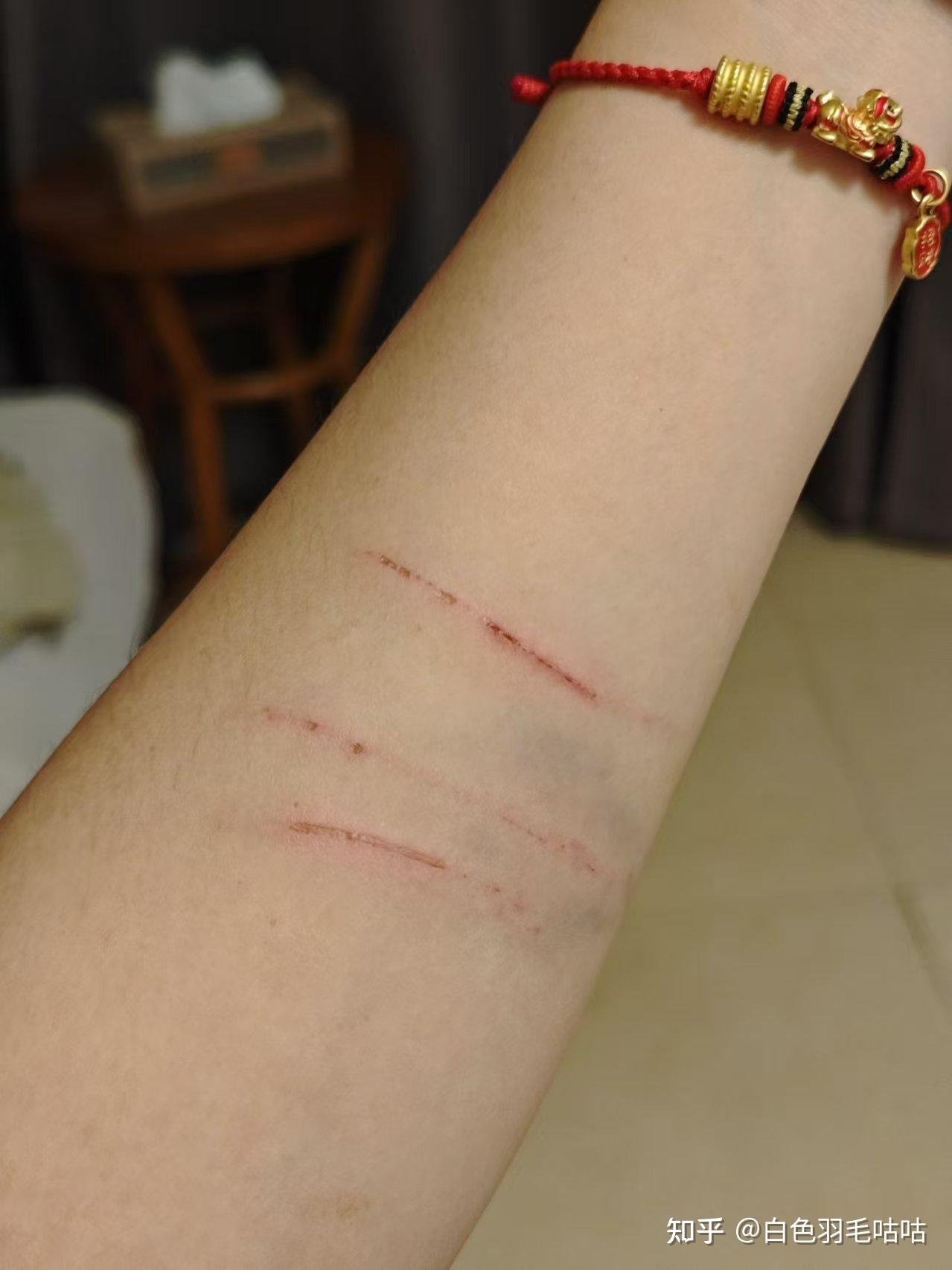 被猫抓了结痂后留下红色疤痕怎么祛除?