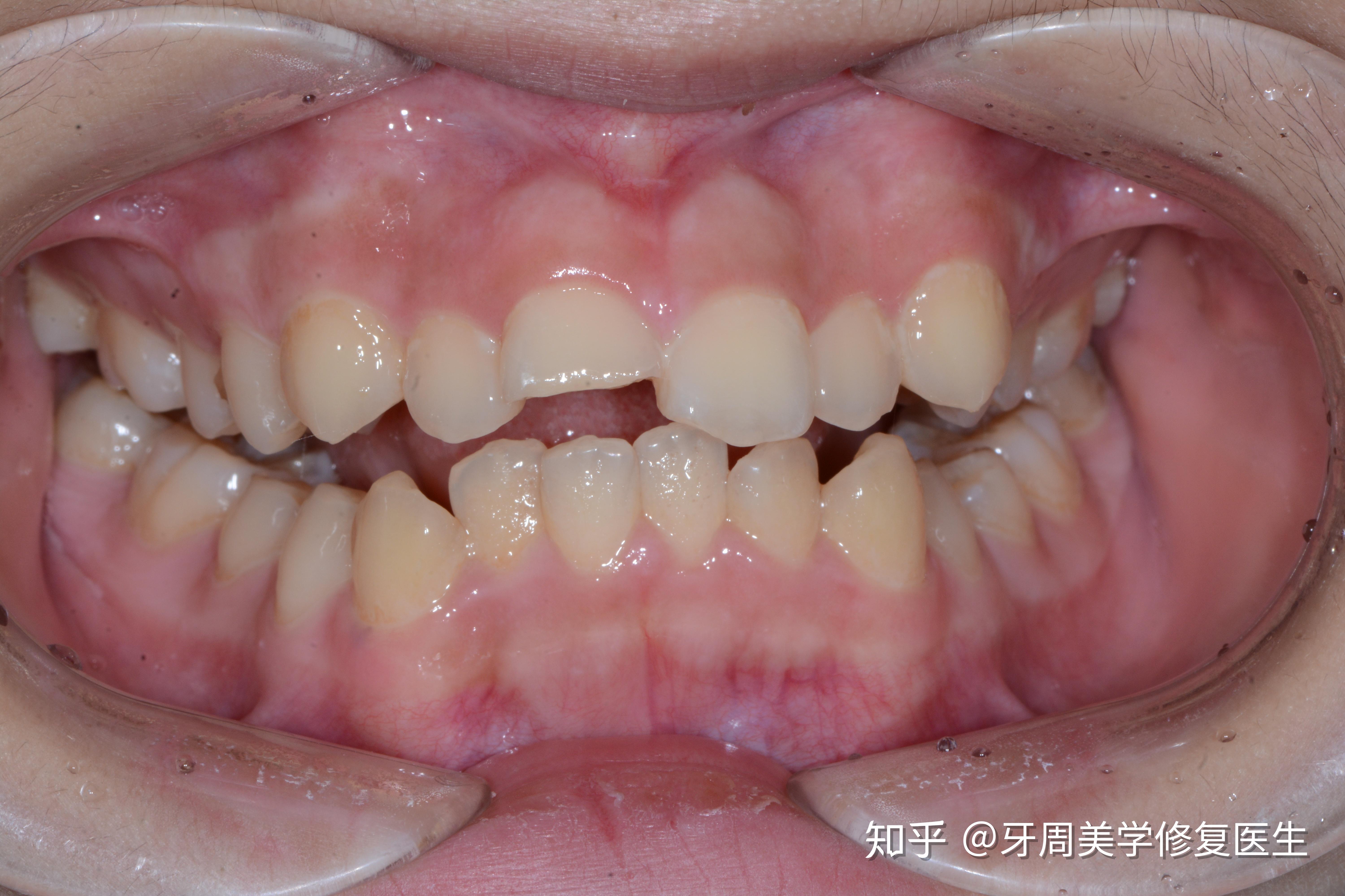 前牙美容树脂修复