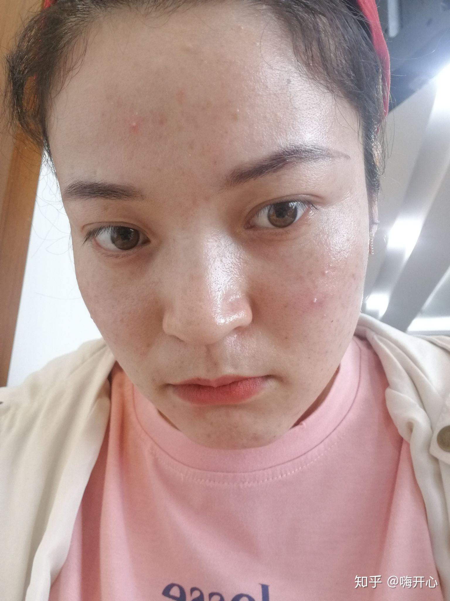 怎么看待五官漂亮但是皮肤差的女性?