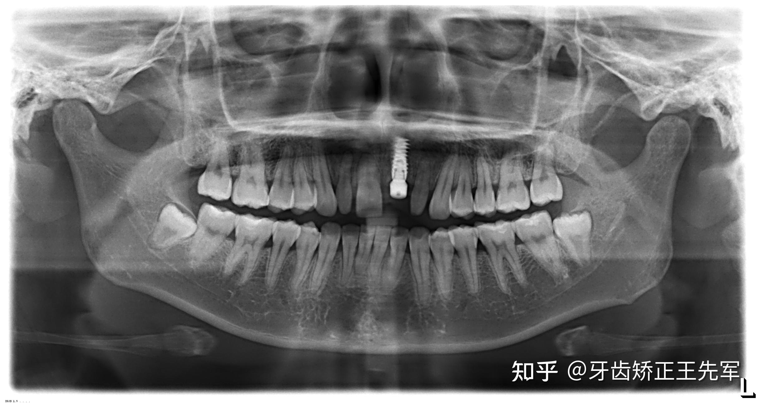 苏州牙齿矫正进口托槽自锁牙套矫正案例分享
