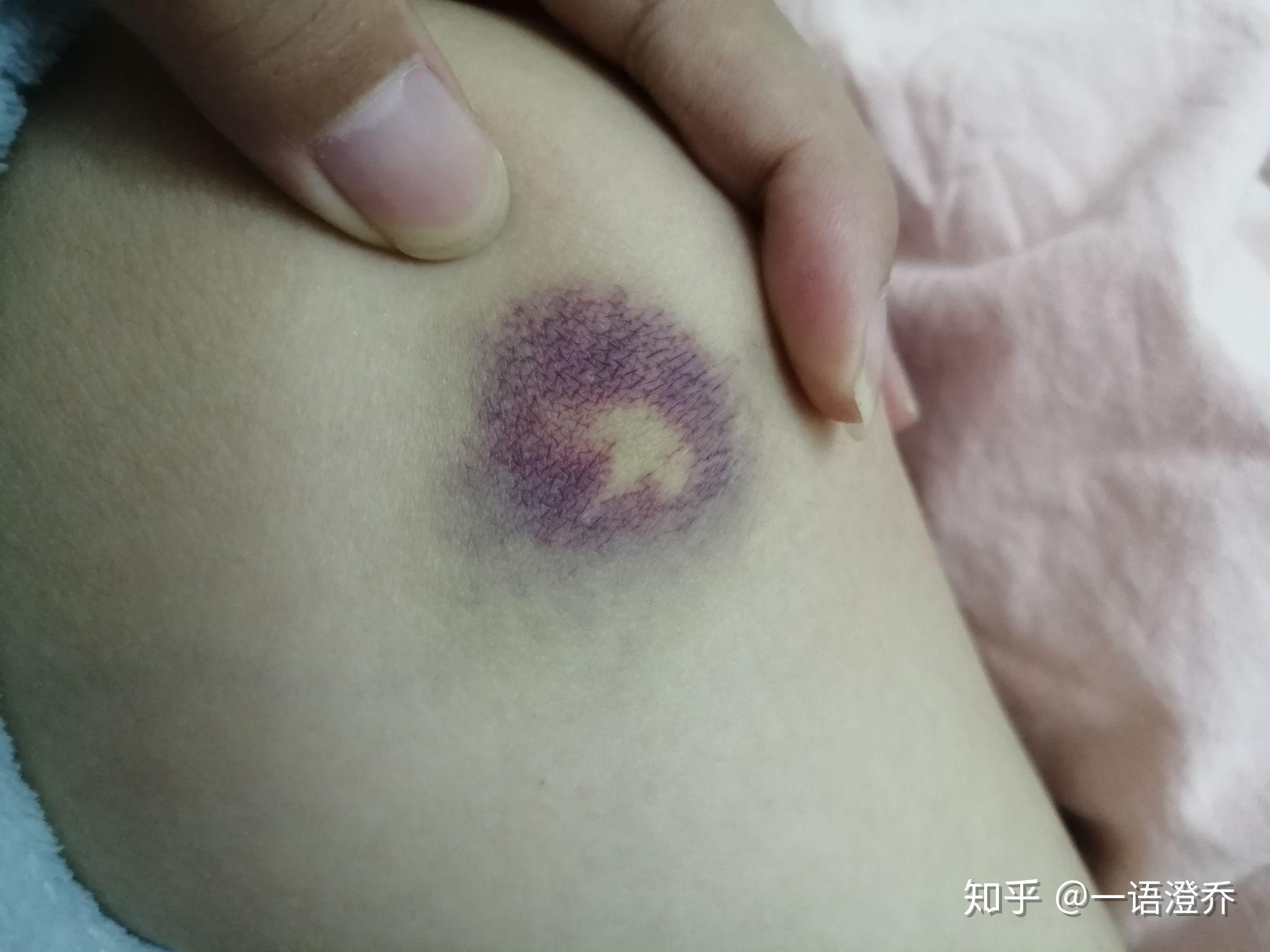 身上总会莫名其妙起淤青是什么原因