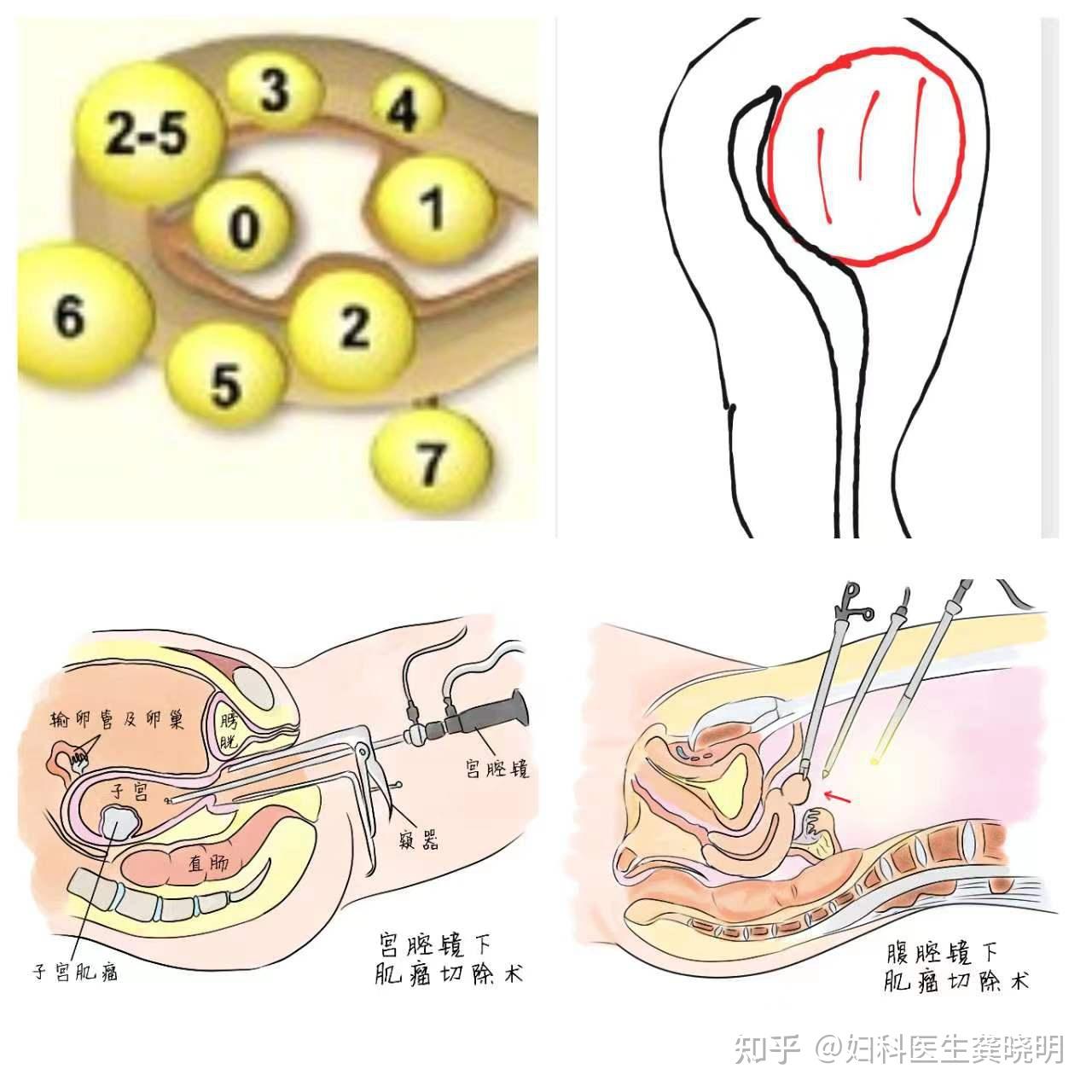 腹腔镜vs宫腔镜子宫肌瘤剔除术