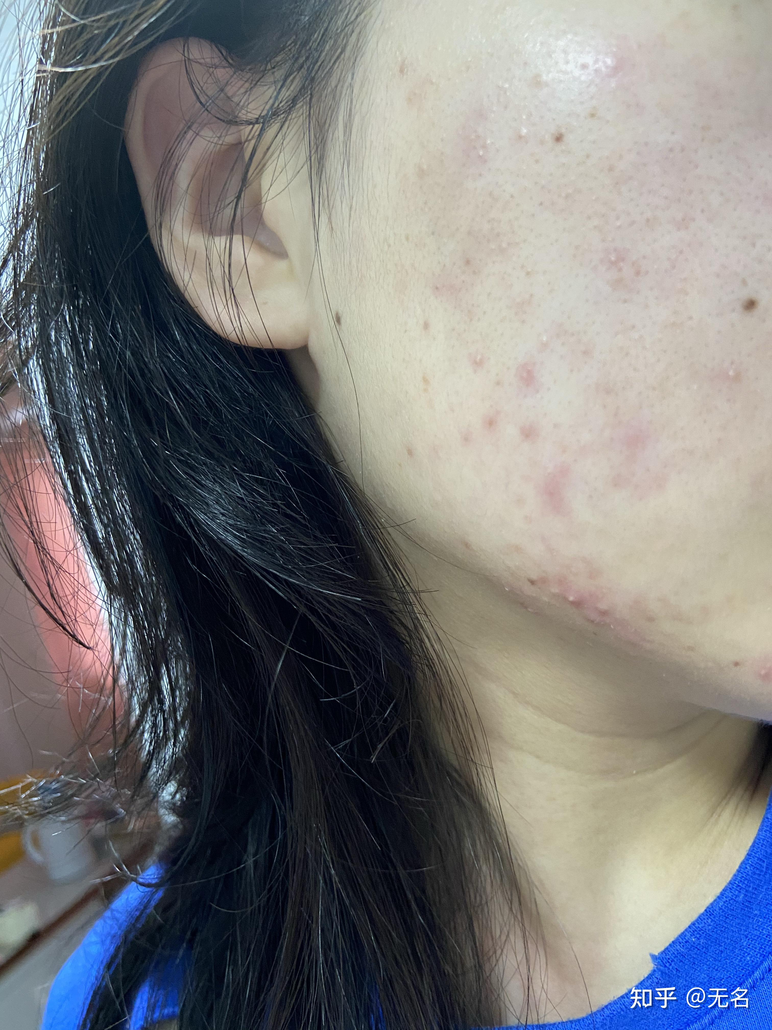 23岁t区偏油脸颊泛红敏感很久不长痘痘了最近长起了痘痘这种情况咋整