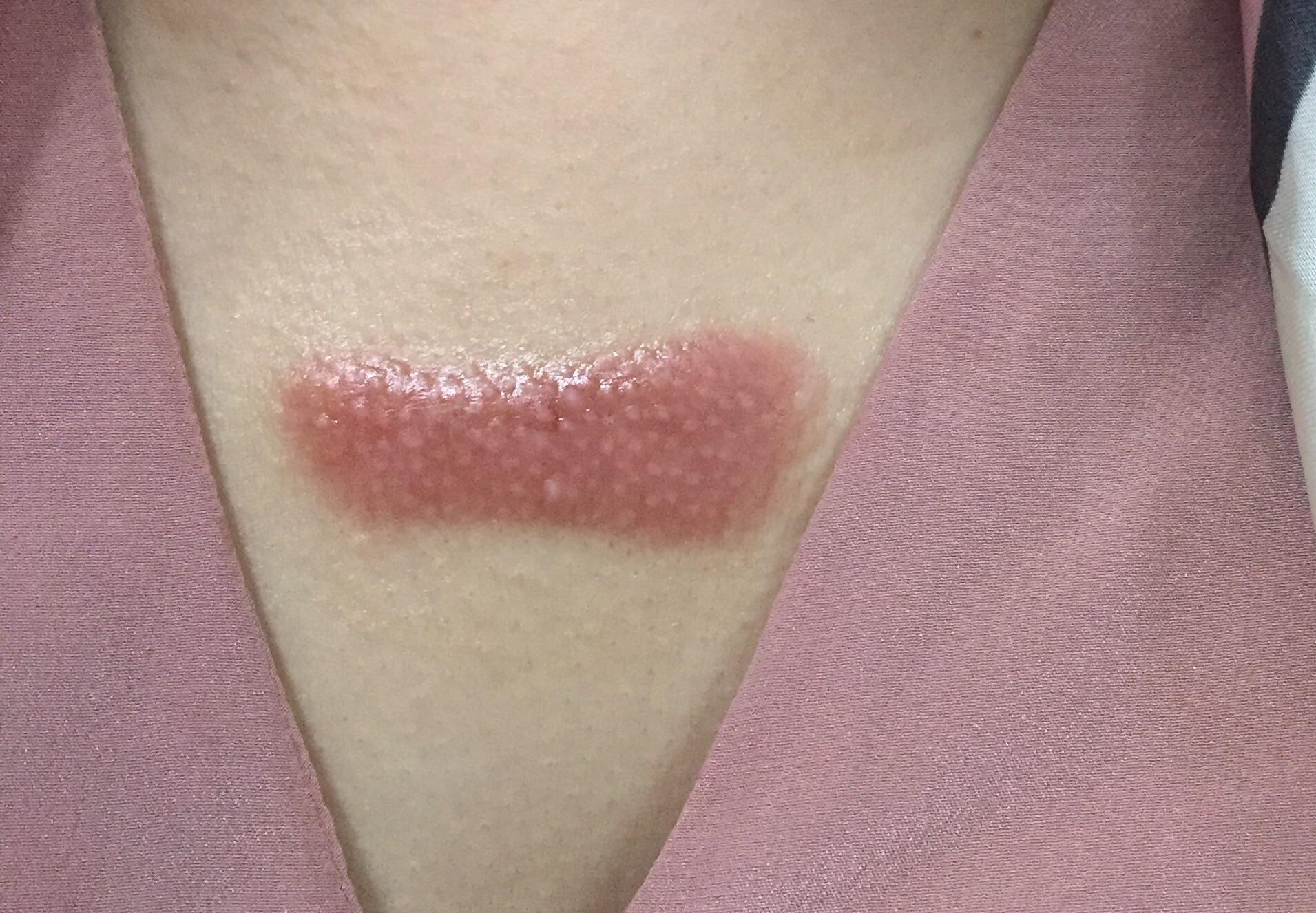 疤痕疙瘩到底怎么治?能不能治好?自己胸前长了一个,增长速度越来越快,