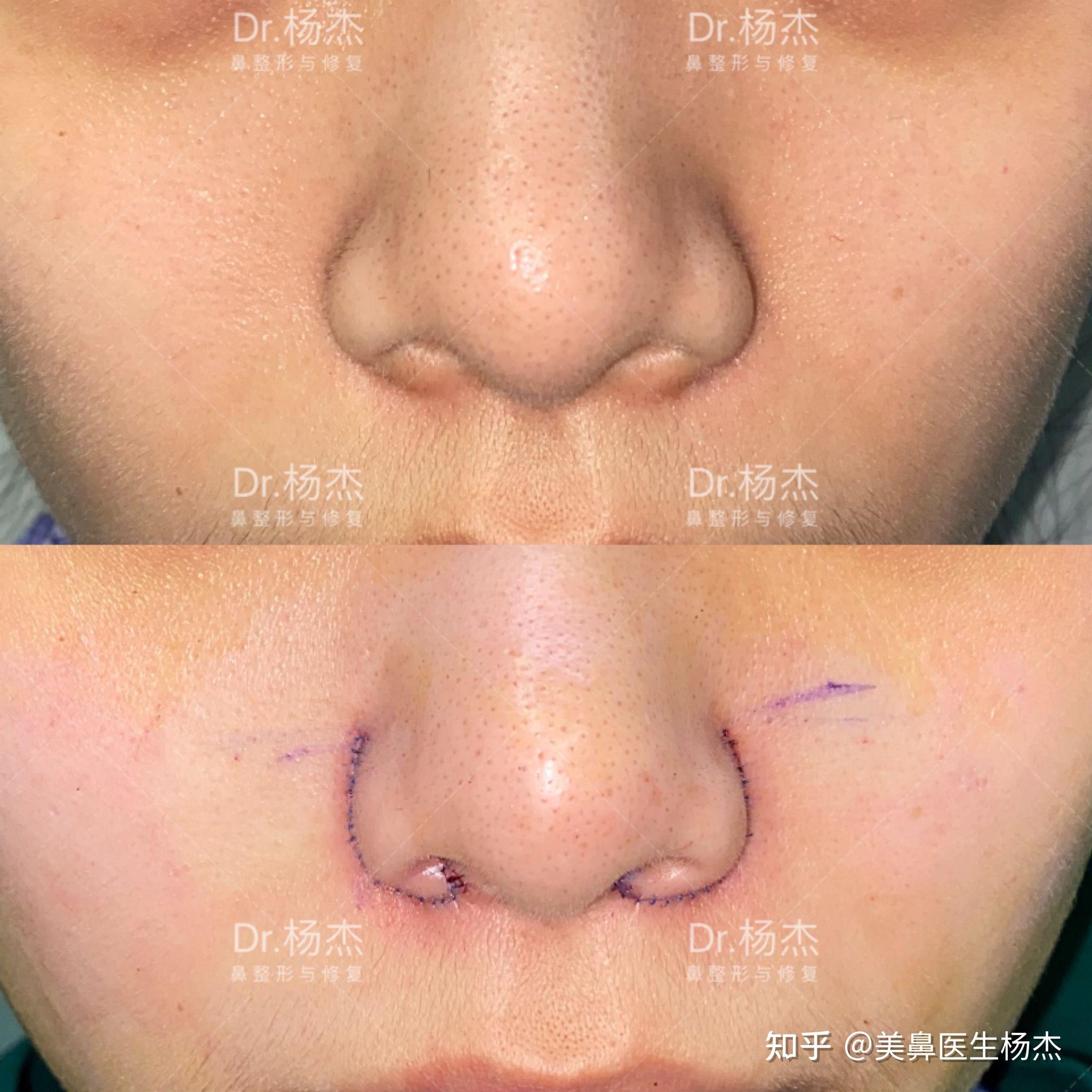 只做了鼻翼外切缩小手术的人对术后效果还满意吗