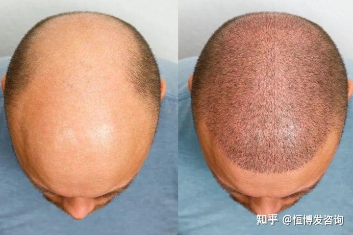 秃头与植发(秃头植发后效果什么样)