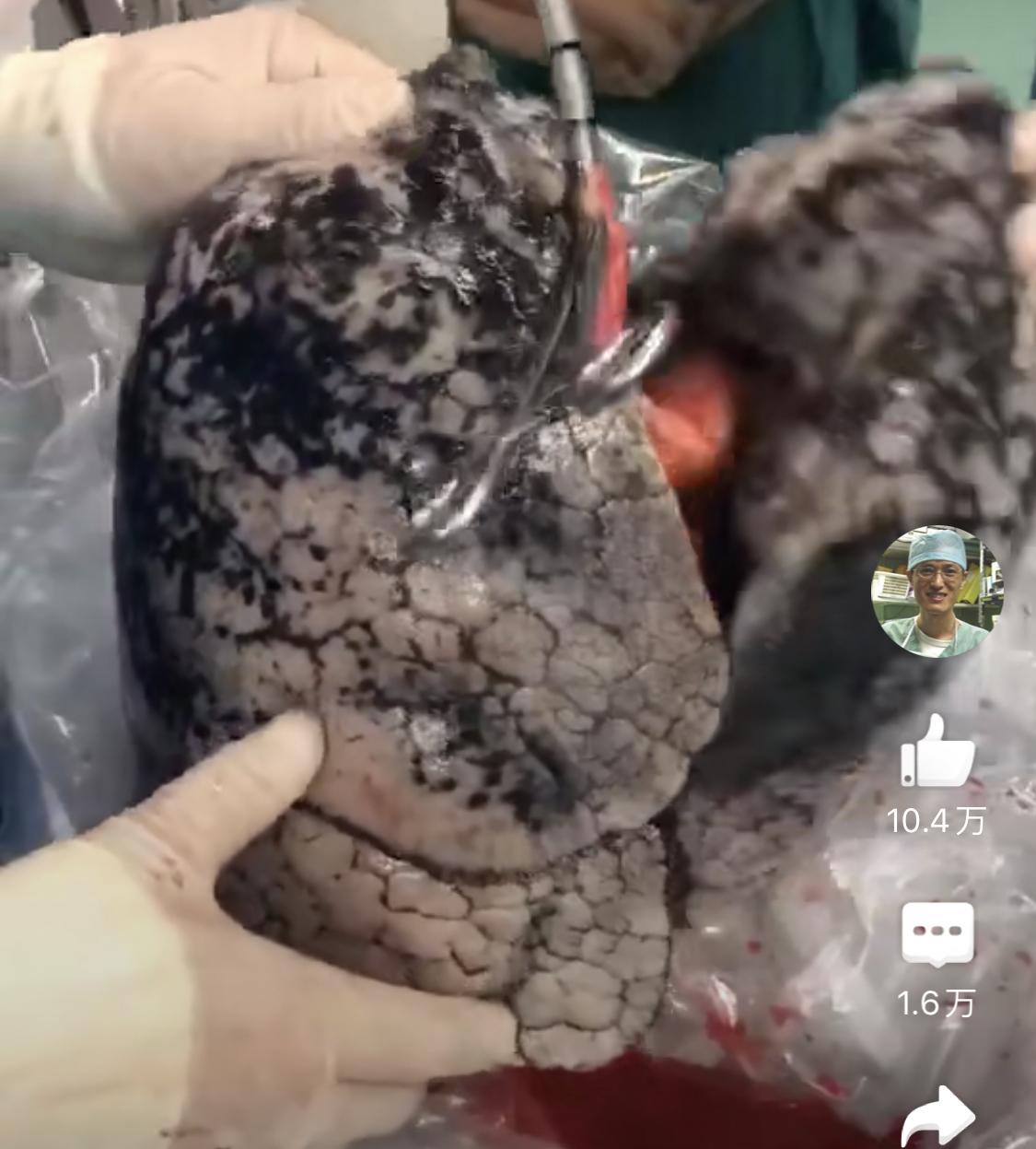 抽烟多久肺会变黑? - 知乎