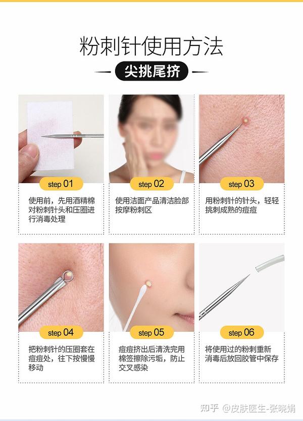 痘肌必看！痘肌可以做哪些医美？ - 知乎