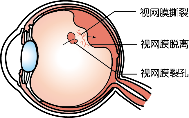 1,視網膜裂孔,脫離