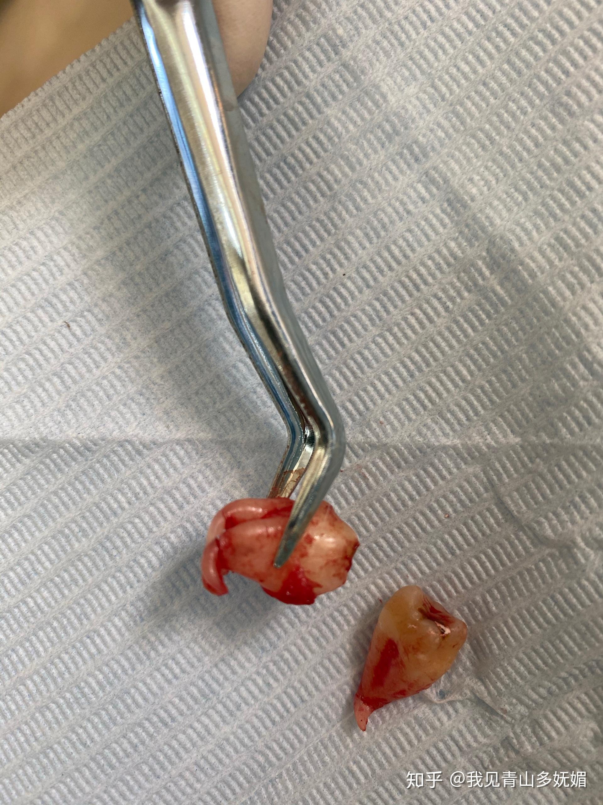 请问智齿牙根是弯的好拔吗? - 知乎