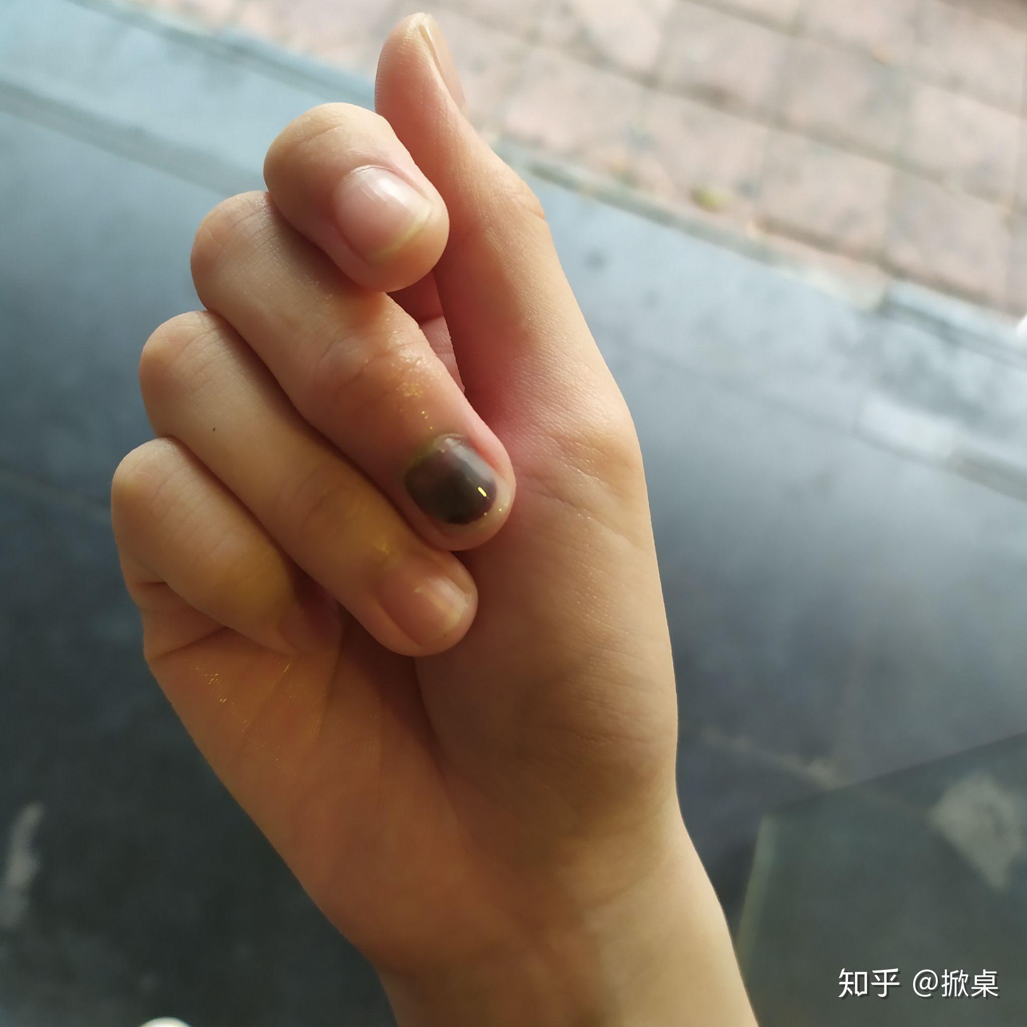 刚被夹 热乎的 立刻去药店买了万花油 先后采用冰热敷 无果 大概也没