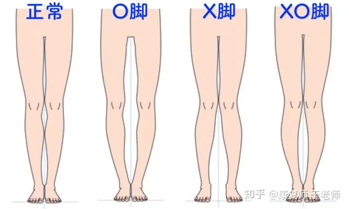 xo型腿如何靠按摩或鍛鍊矯正