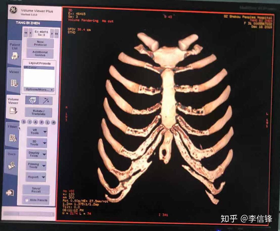 老李说鼻子 浅谈肋软骨钙化问题