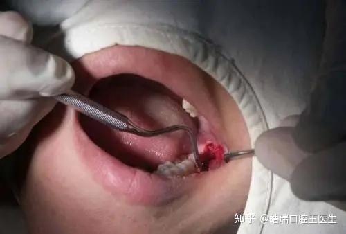 出现智齿冠周炎,又长期没有得到治疗,导致齿槽骨破坏缺损,面颊被脓肿