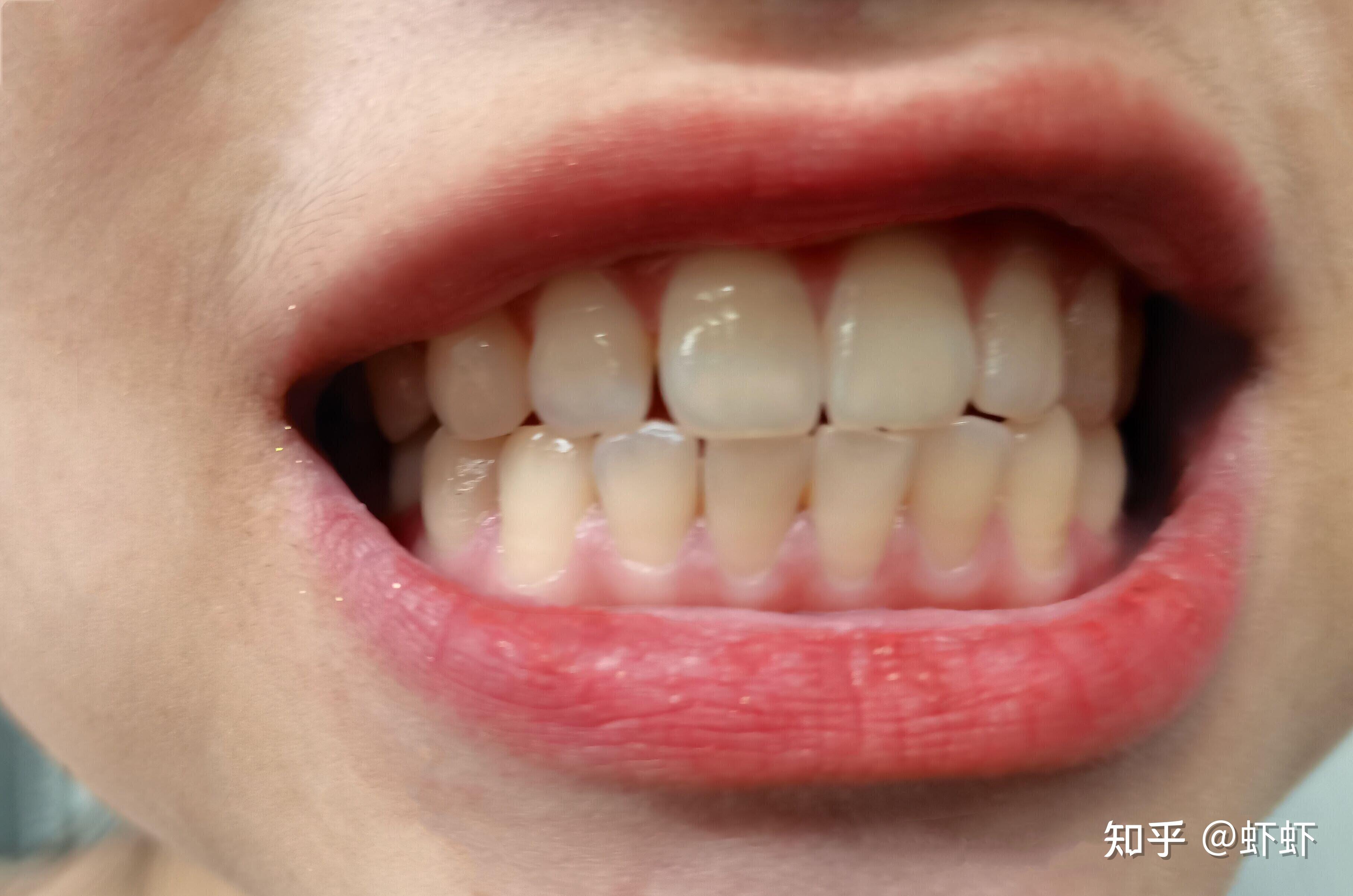 如何分辨黄牙属于内源性还是外源性？_广州德伦口腔